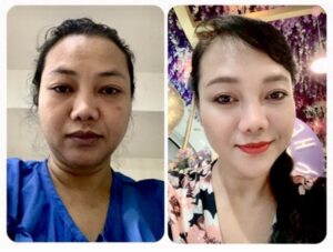 Before and after photos of a Thai woman side by side for Working on our Journey